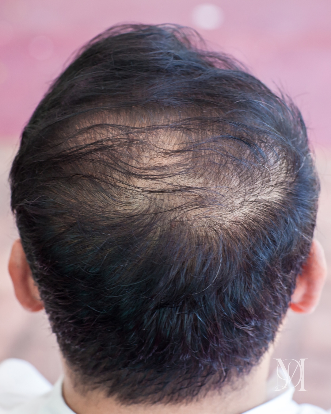 Post Hair Transplant Thinning_smp bkk