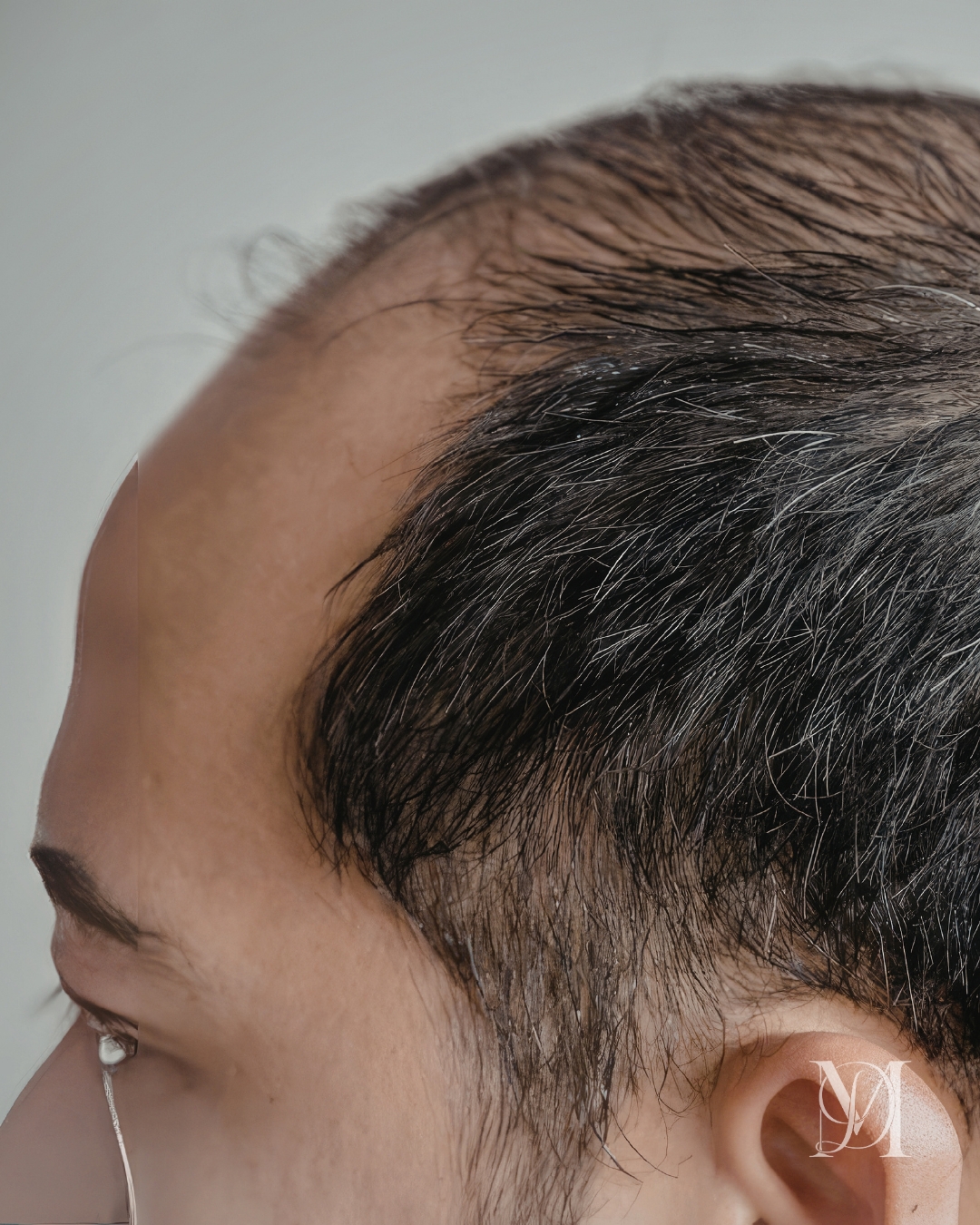 Wide Parting_Scalp Micropigmentation