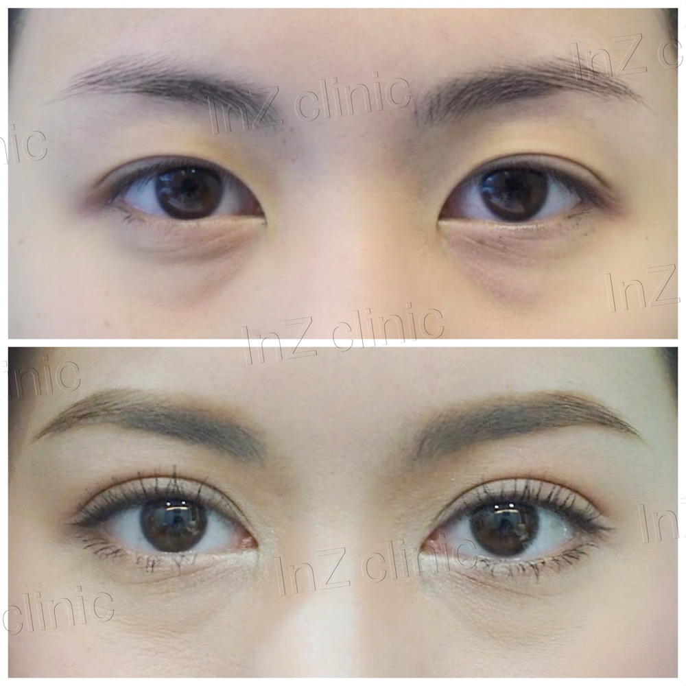 double eyelid surgery suture technique