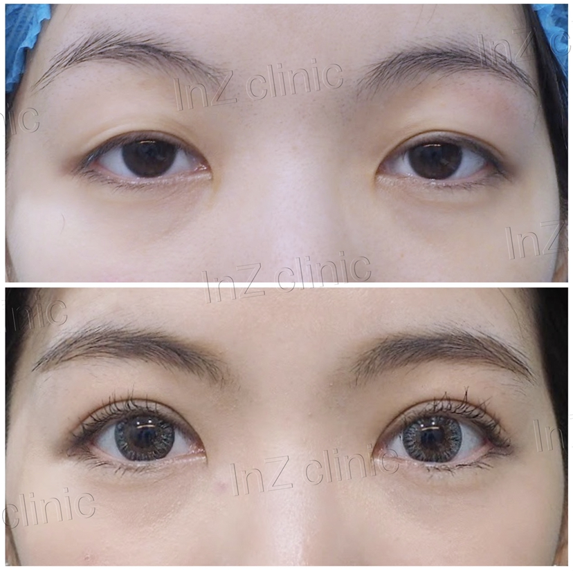 double eyelid surgery swelling
