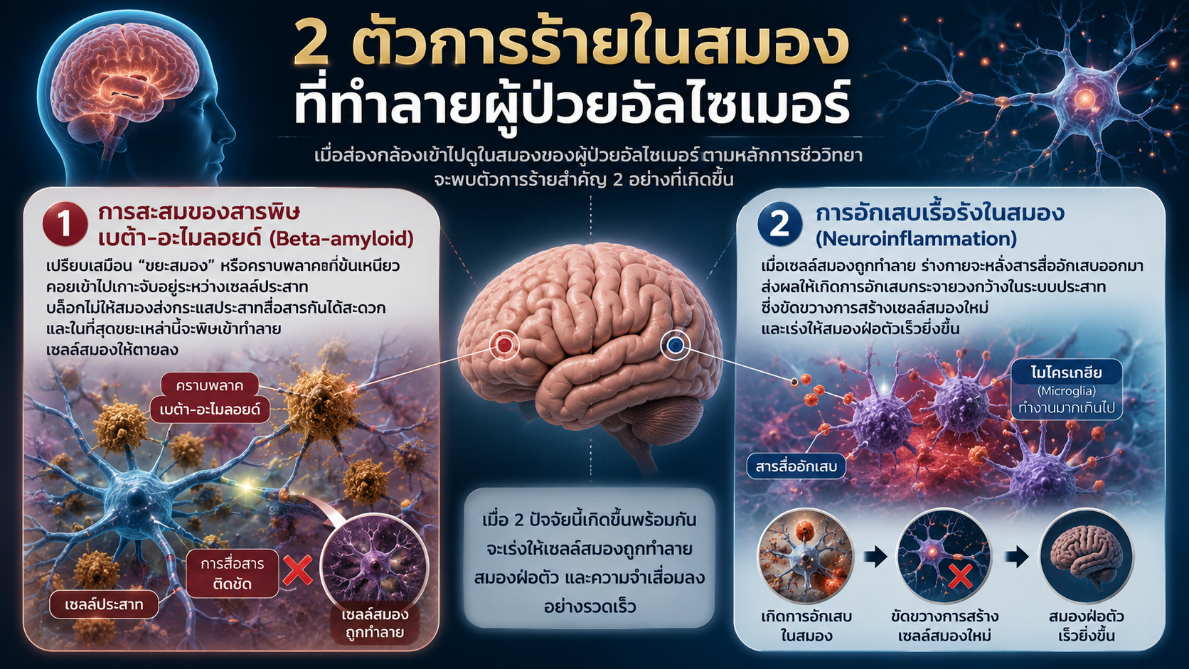 2 ตัวทำลายระบบประสาท Beta-Amyloid การอักเสบเรื้อรังในสมอง