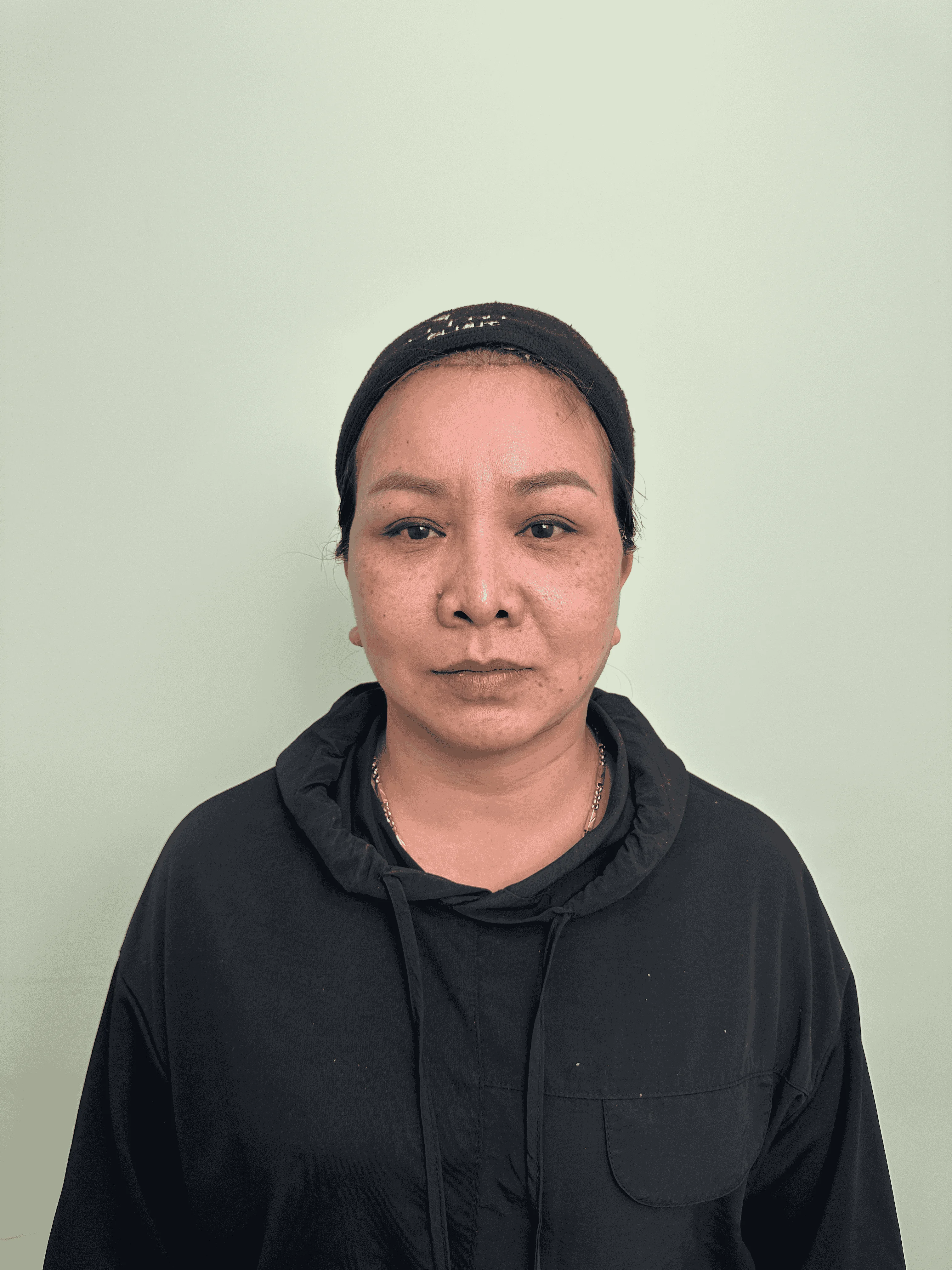 เคสดึงหน้าผาก 