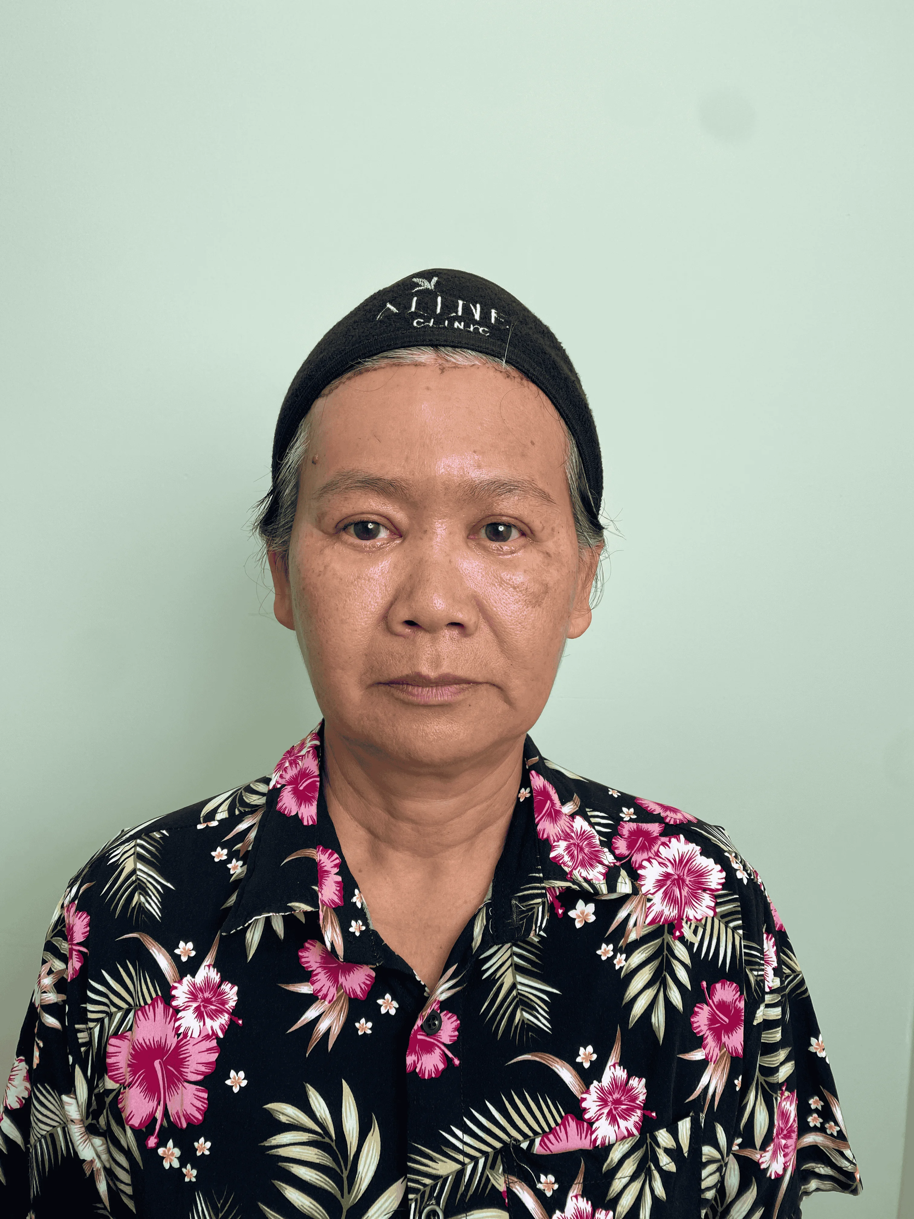 เคสดึงหน้าผาก 