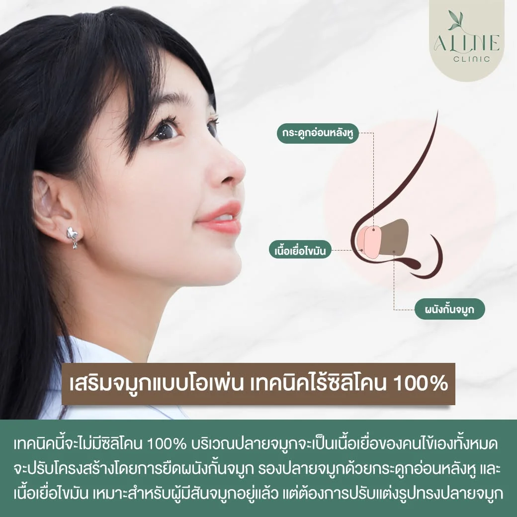 เสริมจมูกโอเพ่น เทคนิคไร้ซิลิโคน