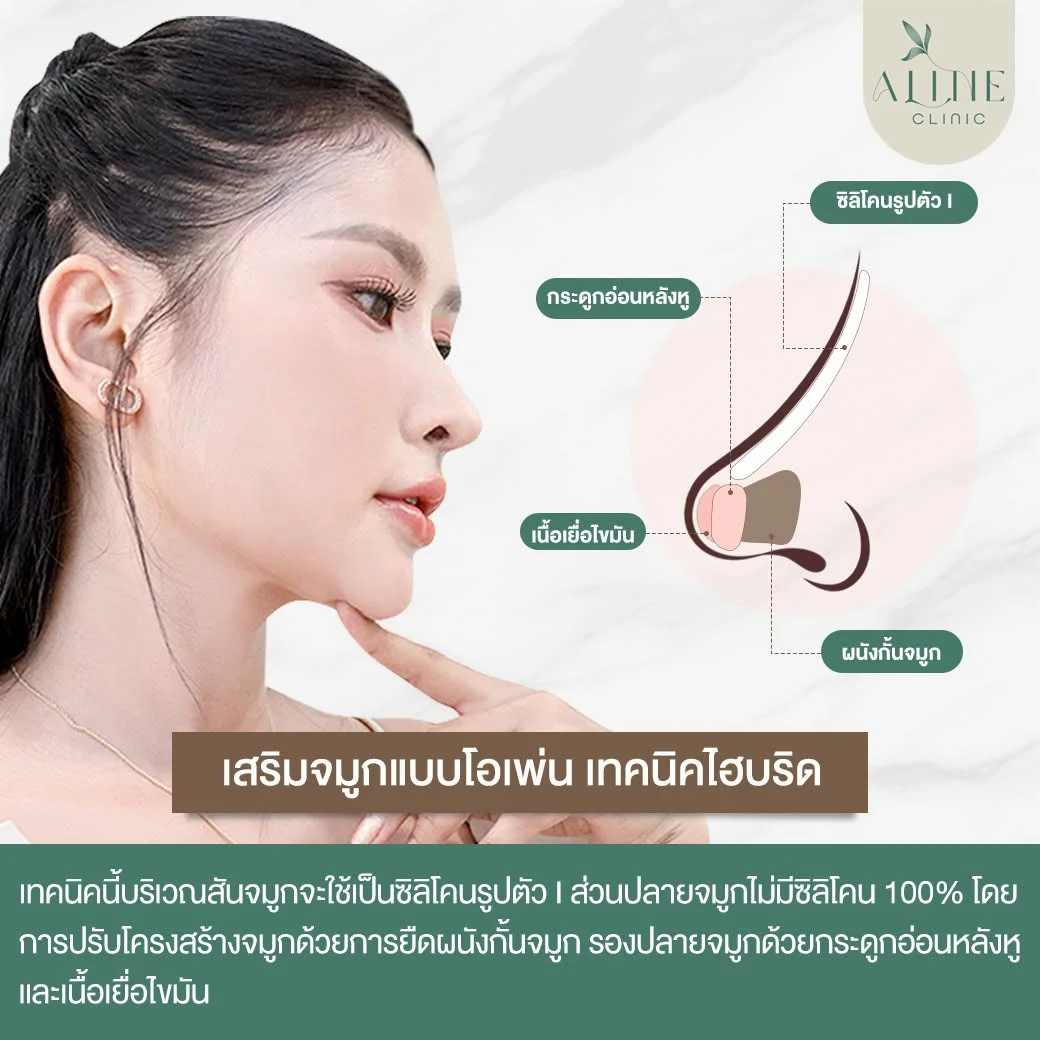 เสริมจมูกโอเพ่น เทคนิคไฮบริด Hybrid