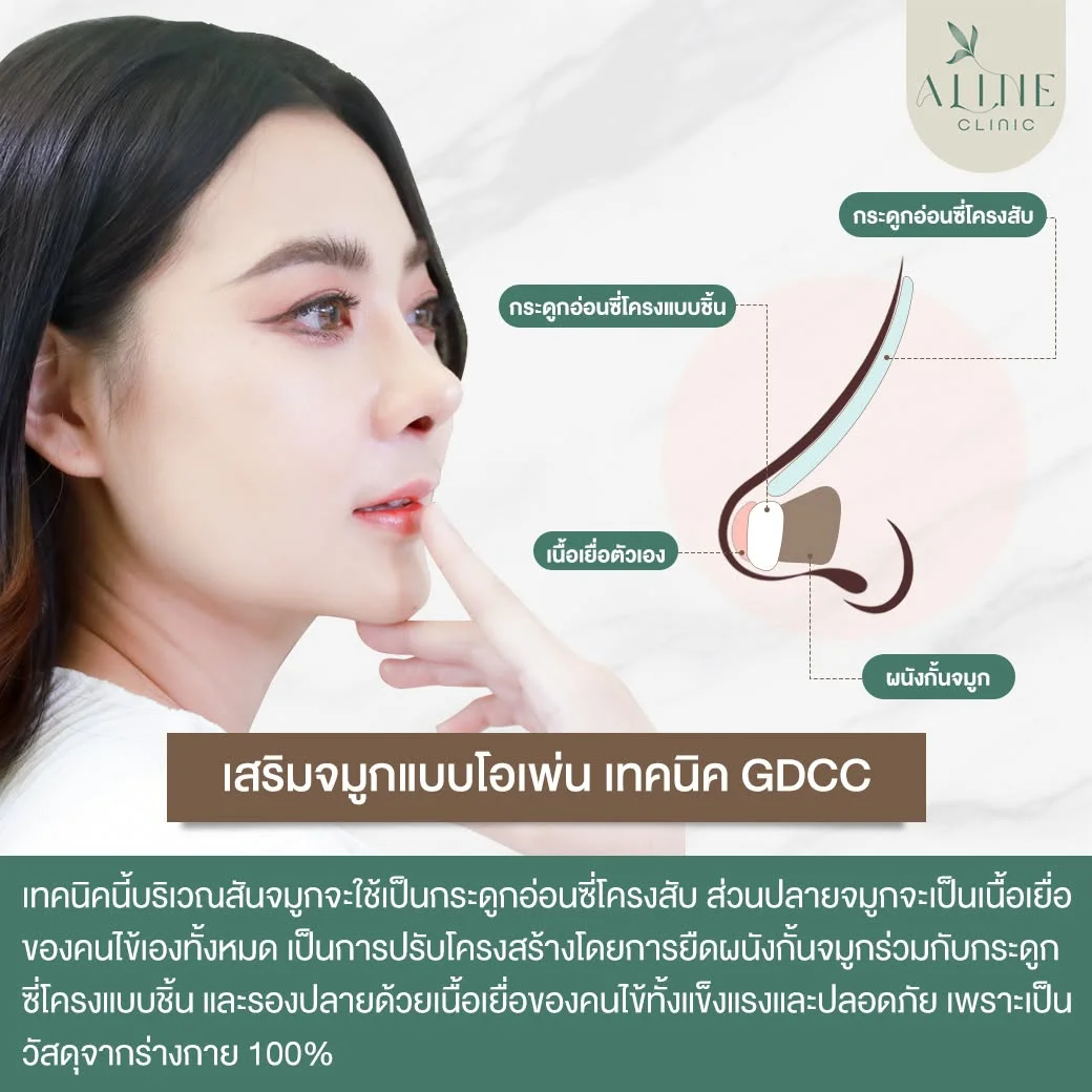 เสริมจมูกโอเพ่น เทคนิคกระดูกอ่อนซี่โครง GDCC