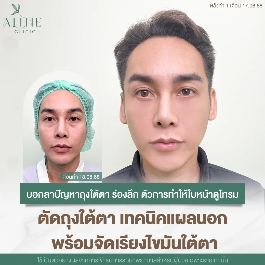 รีวิวเคสผ่าตัดถุงใต้ตา ผู้ชาย