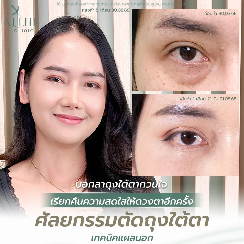 รีวิวเคสผ่าตัดถุงใต้ตา ผู้หญิง