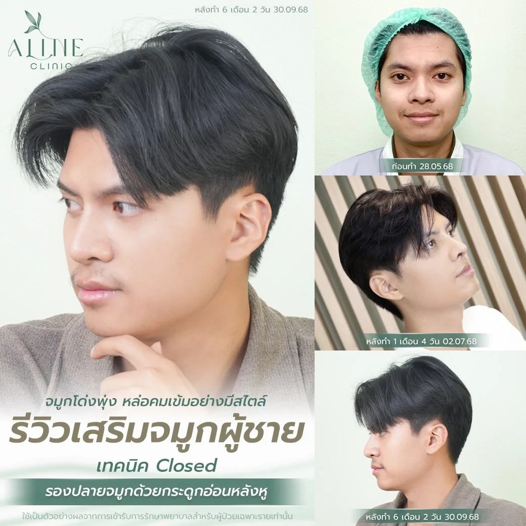 เสริมจมูกแบบปิด Closed Rhinoplasty ALINE Clinic
