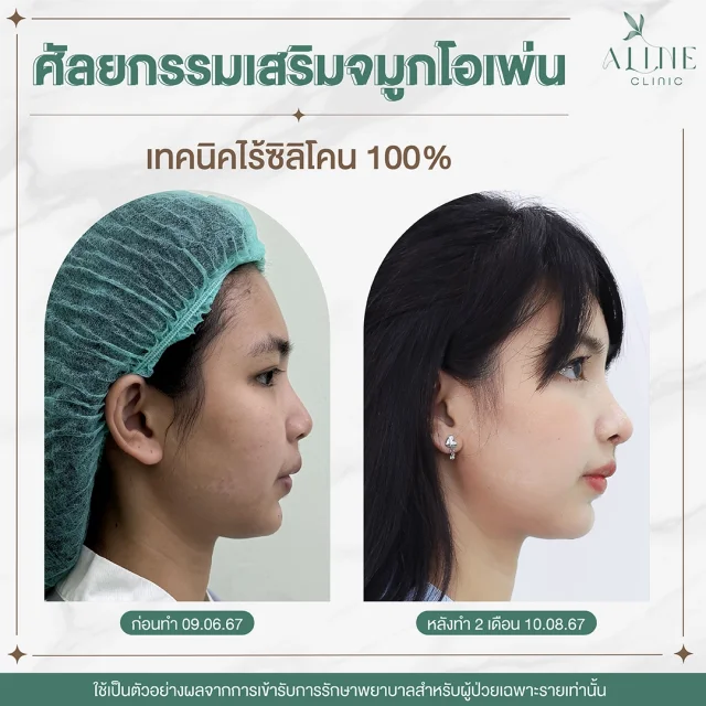 เสริมจมูกแบบเปิด Open Rhinoplasty ALINE Clinic