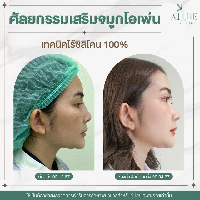 เสริมจมูกแบบเปิด Open Rhinoplasty ALINE Clinic