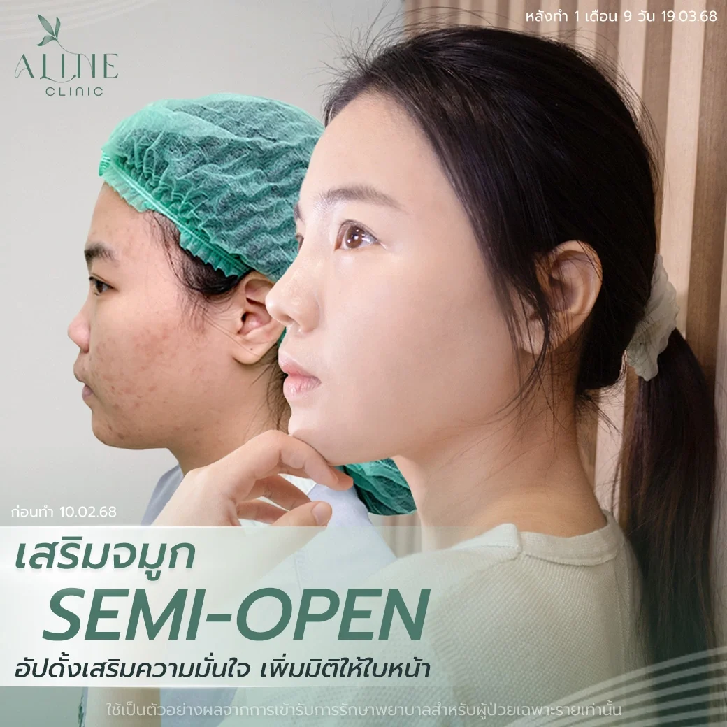 เสริมจมูกแบบ Semi Open Rhinoplasty ALINE Clinic