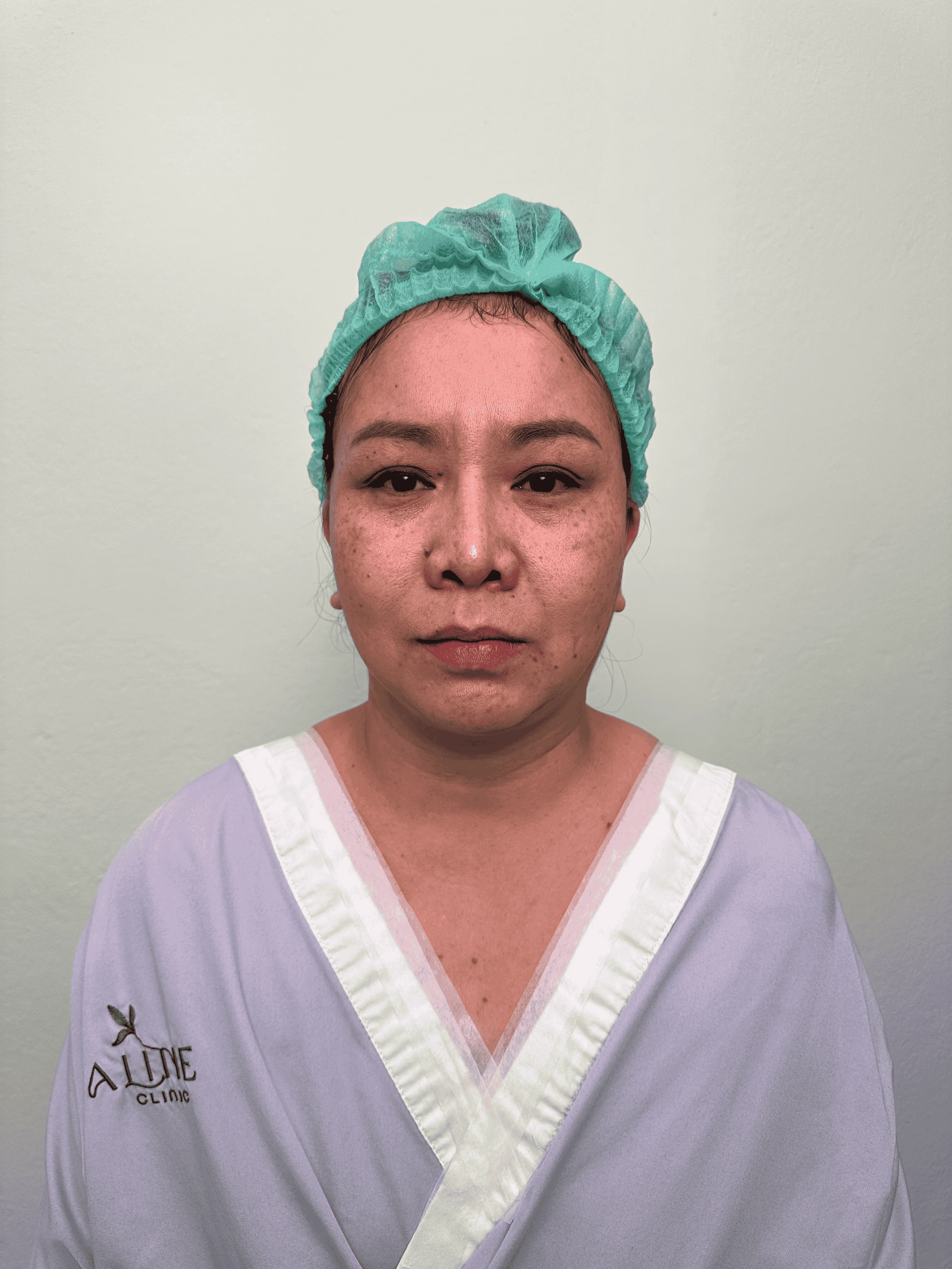 เคสดึงหน้าผาก 