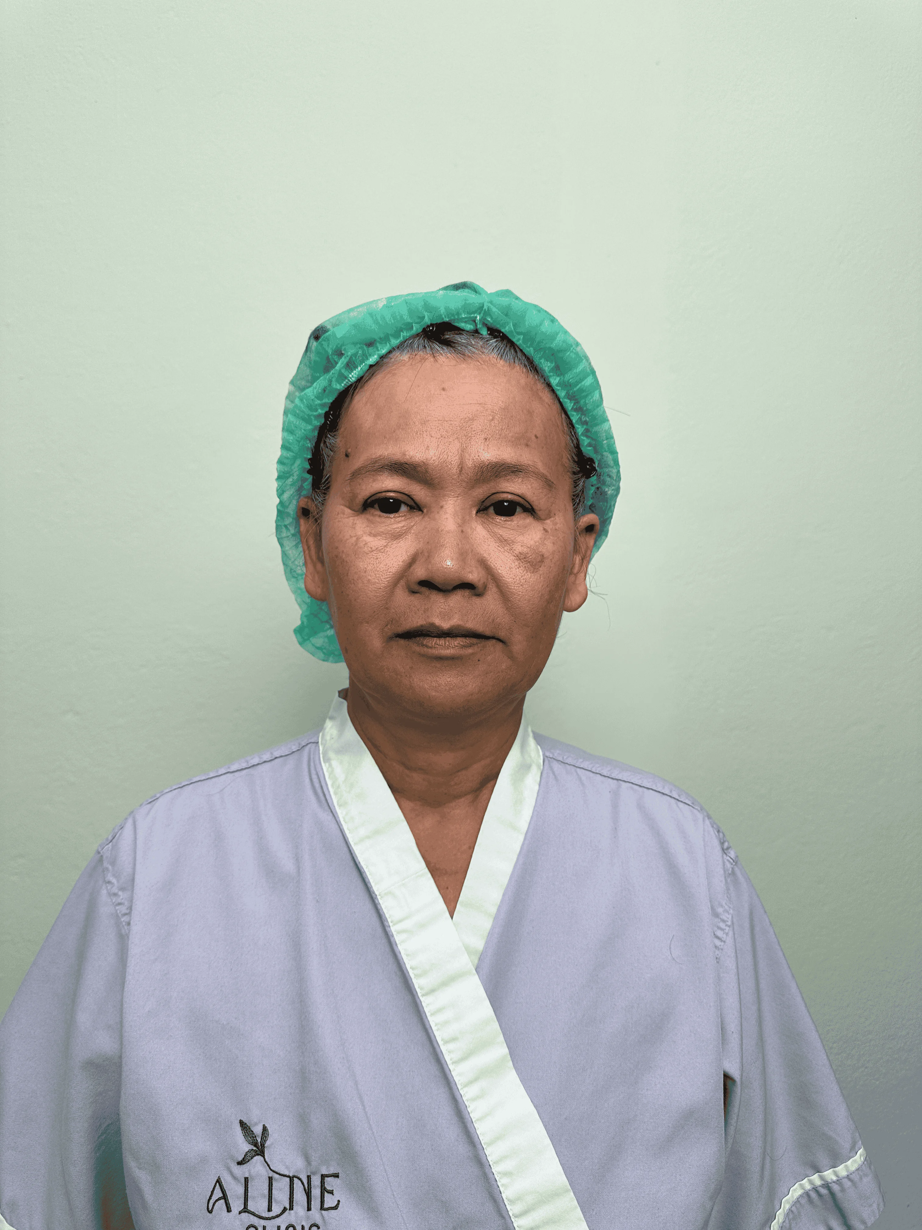 เคสดึงหน้าผาก 