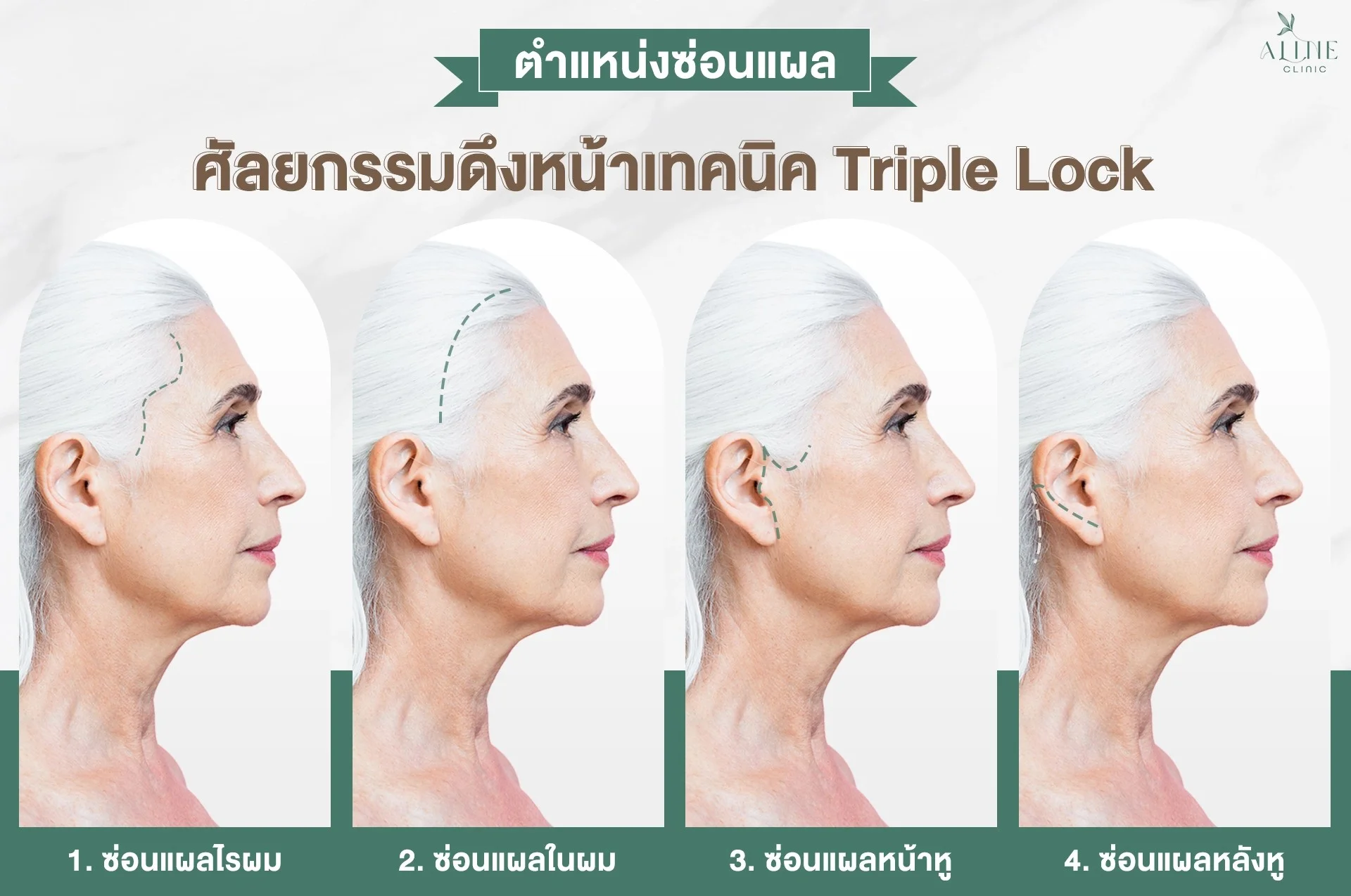 ศัลยกรรมดึงหน้าด้วยเทคนิค Triple Lock