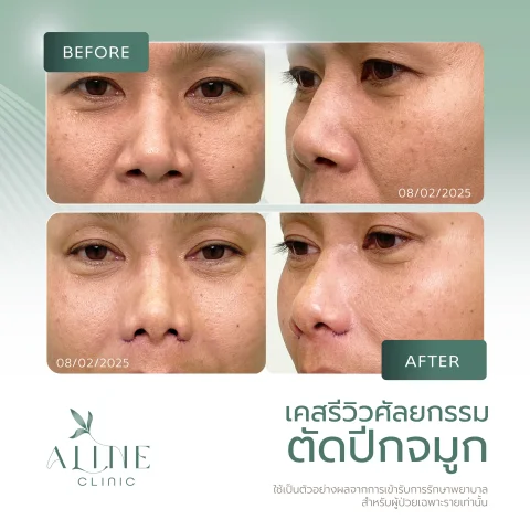 รีวิวตัดปีกจมูก ALINE Clinic