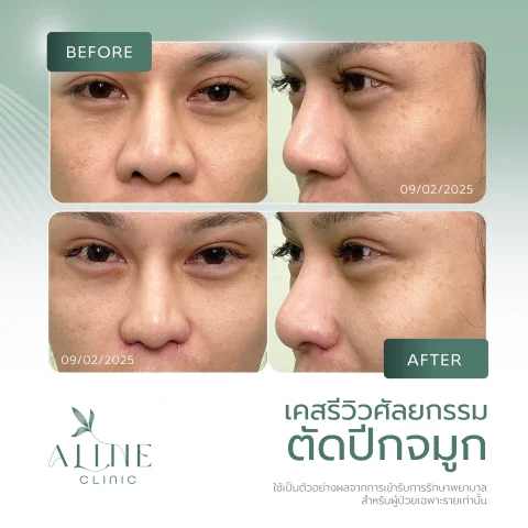 รีวิวตัดปีกจมูก ALINE Clinic