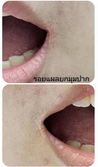 แผลยกมุมปาก แผลยกมุมปาก