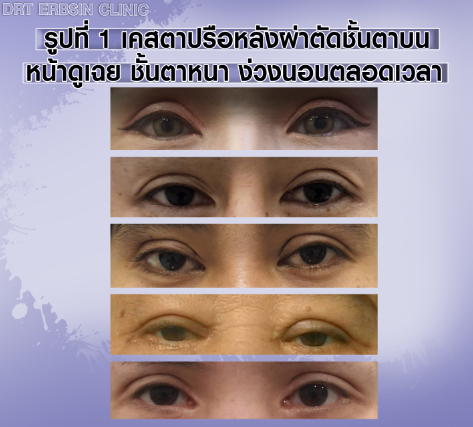 ตาปรือ ตาหอยแครง ตาล๊อค  ตาปรือ ตาหอยแครง ตาล๊อค