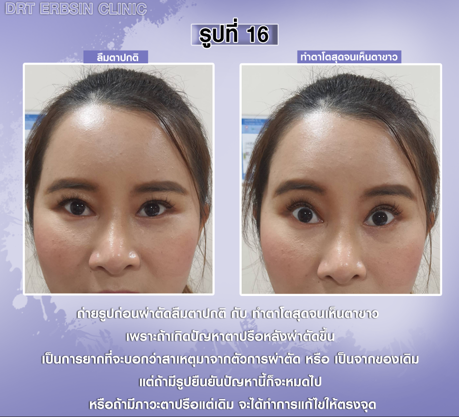 รูปลืมตาปกติและทำตาโต