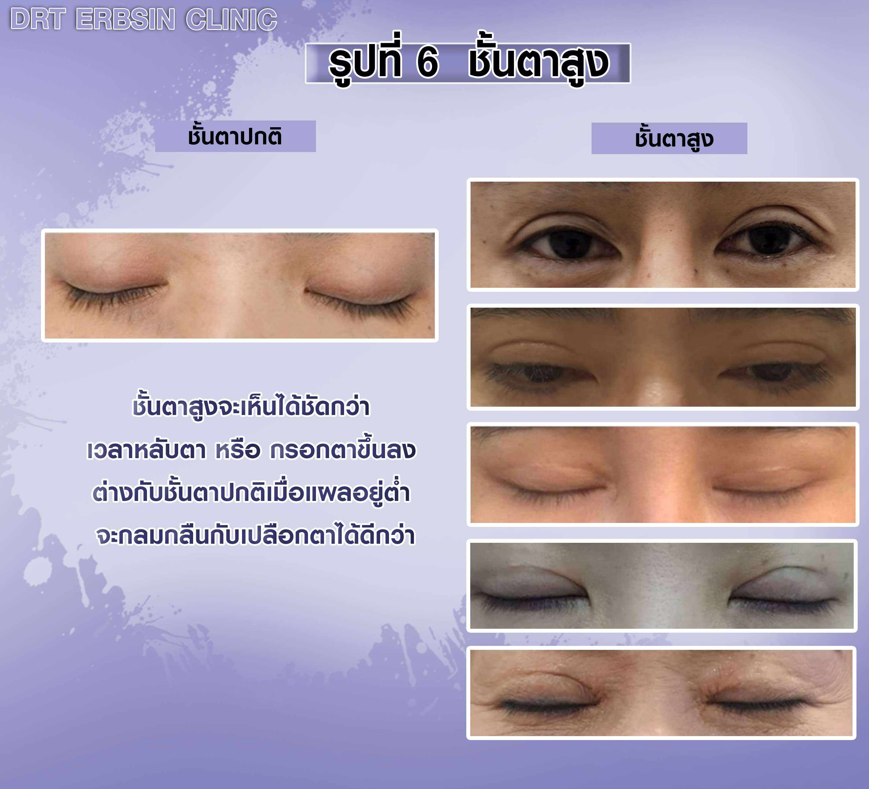 เปรียบเทียบแผลชั้นตาเวลาต่างๆ เปรียบเทียบแผลชั้นตาเวลาต่างๆ