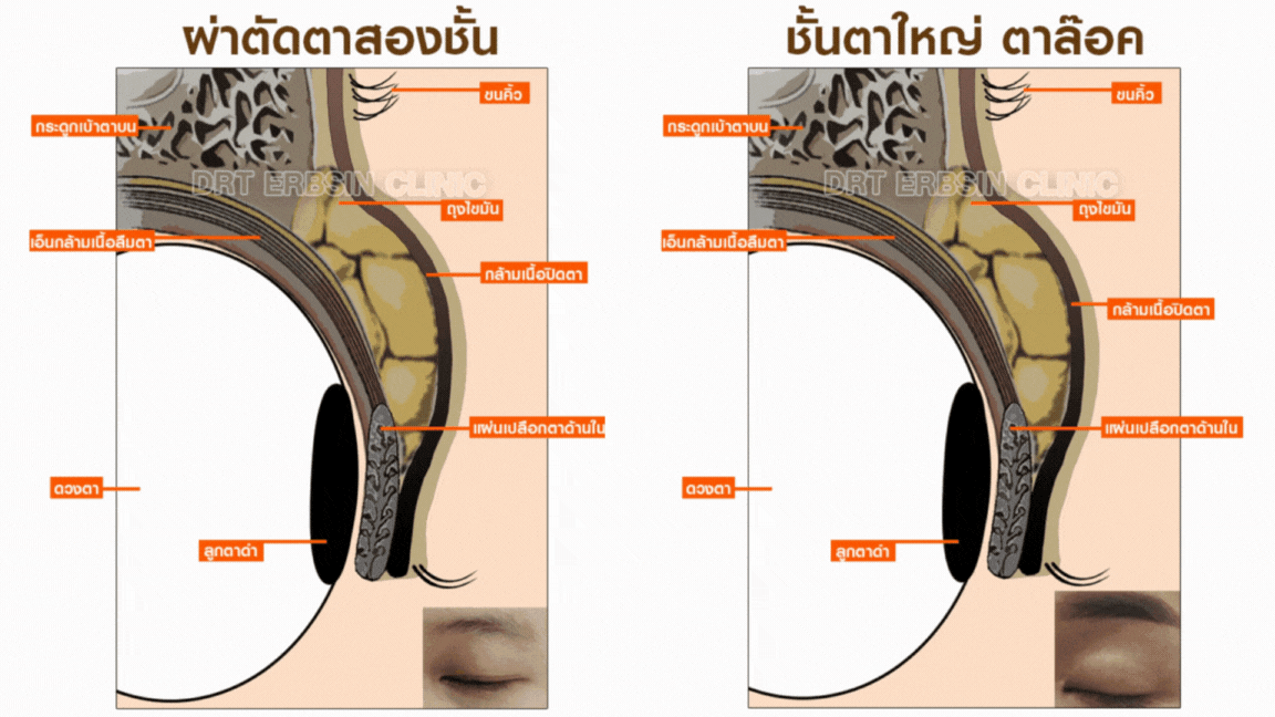 เปรียบเทียบการลืมตาในคนทำชั้นตาปกติและสูงเกินไป เปรียบเทียบการลืมตาในคนทำชั้นตาปกติและสูงเกินไป