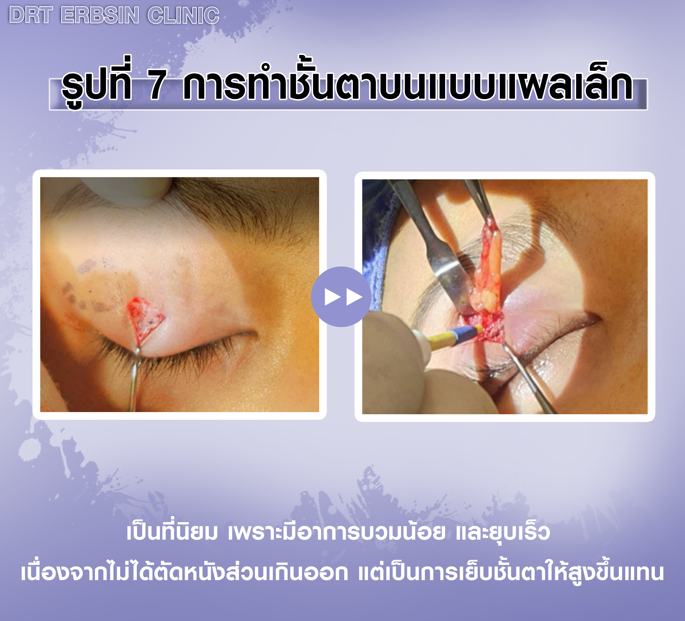 การทำตา2ชั้นแบบแผลเล็ก การทำตา2ชั้นแบบแผลเล็ก