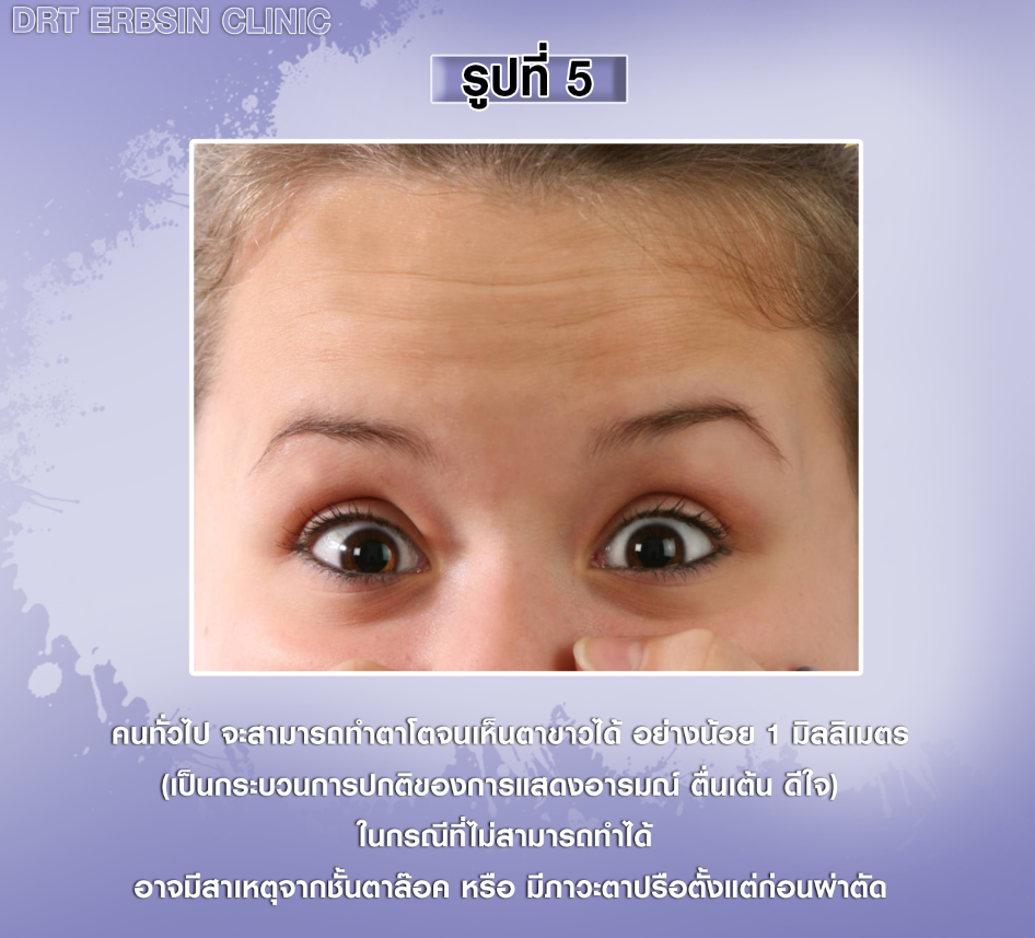 การทำตาโตของคนปกติ