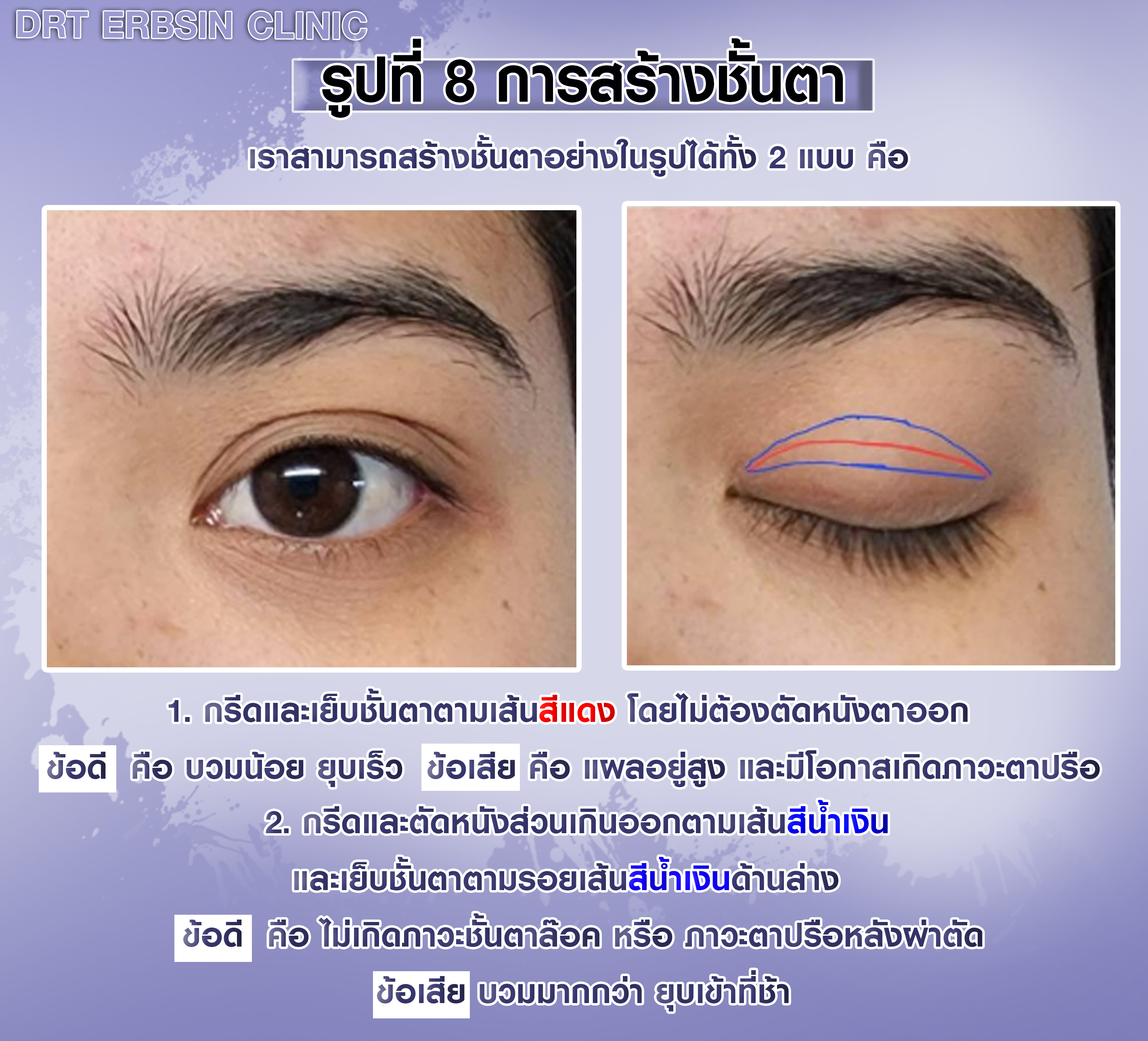 เปรียบเทียบการกรีดชั้นตาสูงกับต่ำแต่ตัดเนื้อ เปรียบเทียบการกรีดชั้นตาสูงกับต่ำแต่ตัดเนื้อ