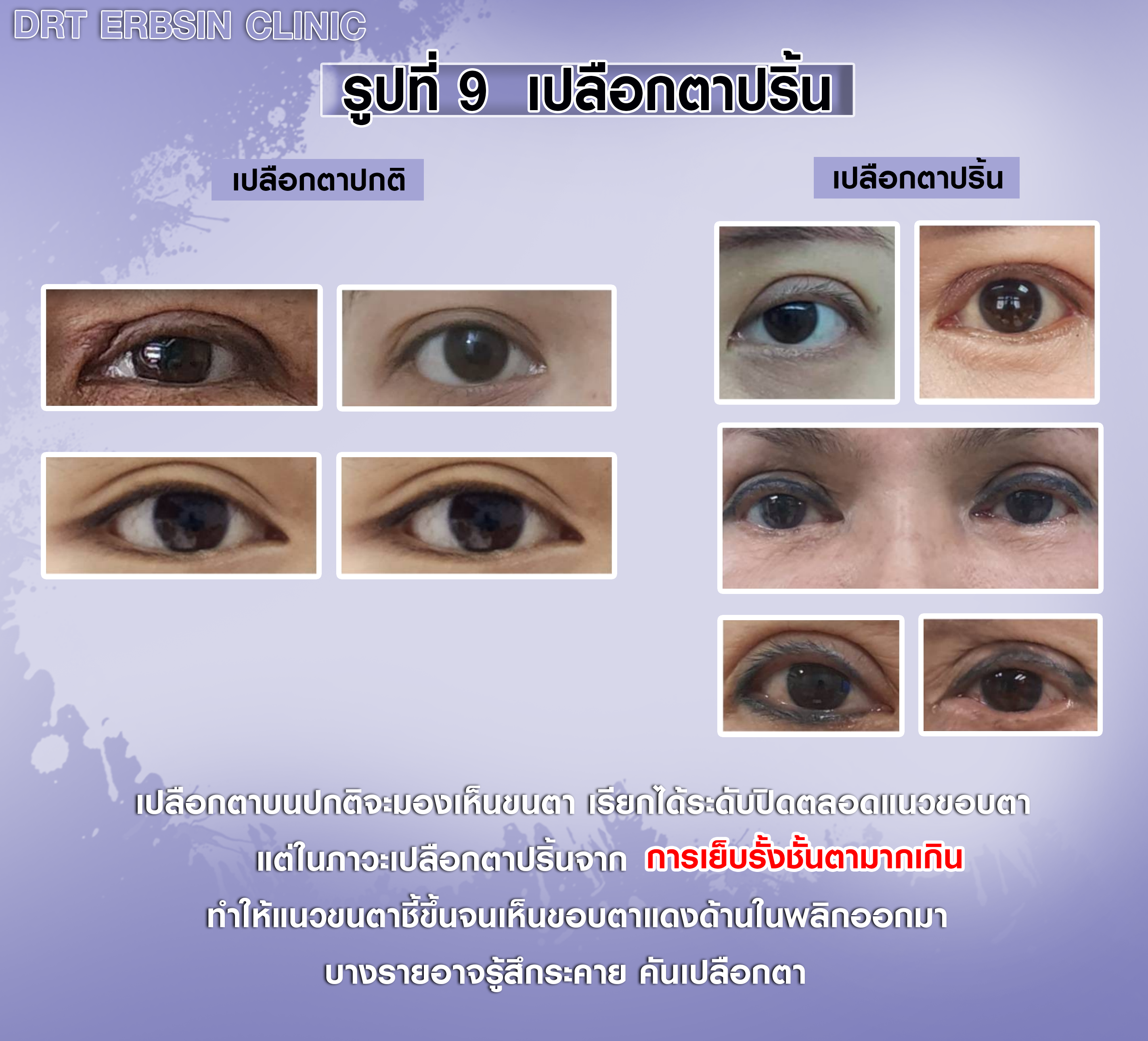 เปรียบเทียบเปลือกตาปกติกับเปลือกตาปลิ้น เปรียบเทียบเปลือกตาปกติกับเปลือกตาปลิ้น