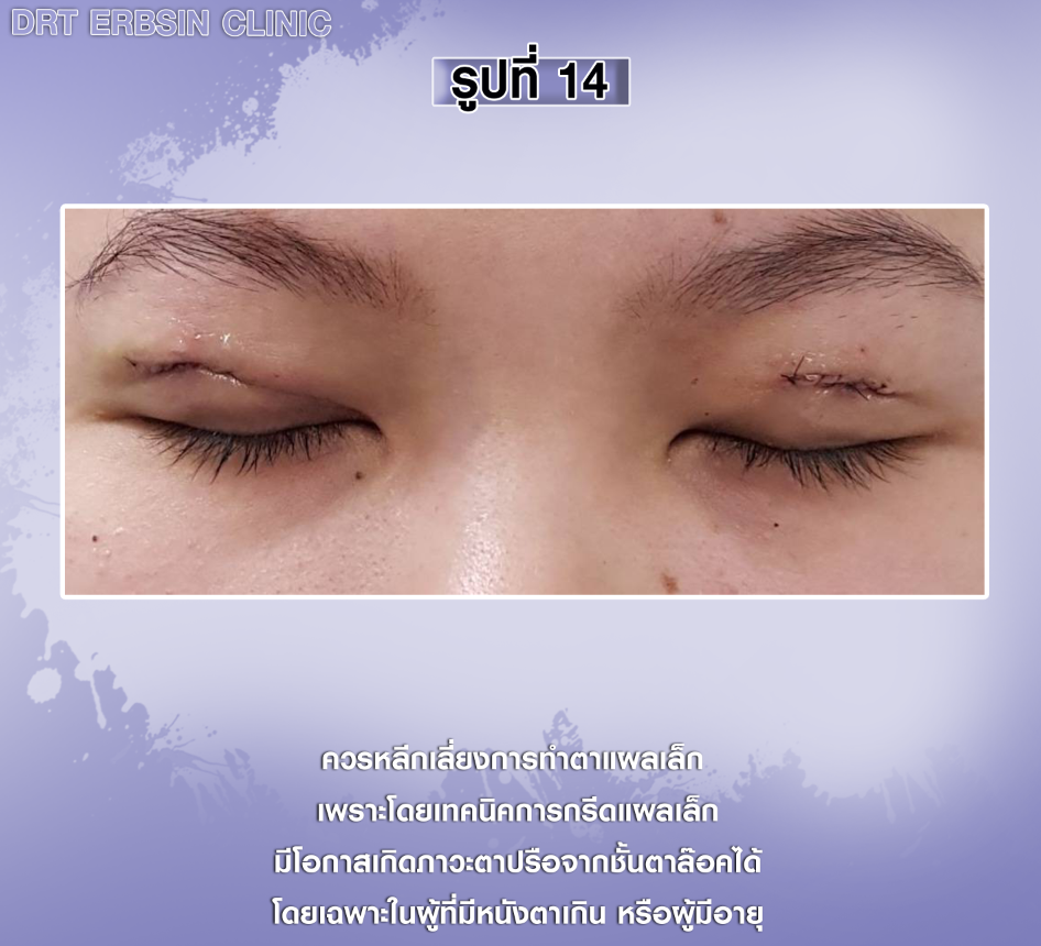 แผลตา2ชั้นแบบแผลสั้น แผลตา2ชั้นแบบแผลสั้น