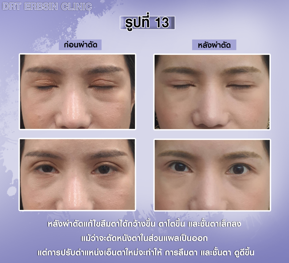 ก่อนหลังผ่าตัดแก้ไขชั้นตาล๊อค ตาหอยแครง ก่อนหลังผ่าตัดแก้ไขชั้นตาล๊อค ตาหอยแครง