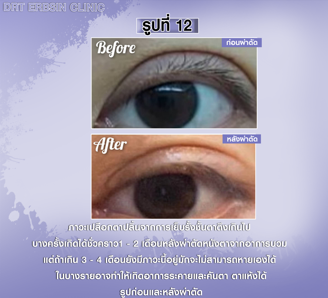 เปลือกตาปลิ้นก่อนหลังผ่าตัด เปลือกตาปลิ้นก่อนหลังผ่าตัด