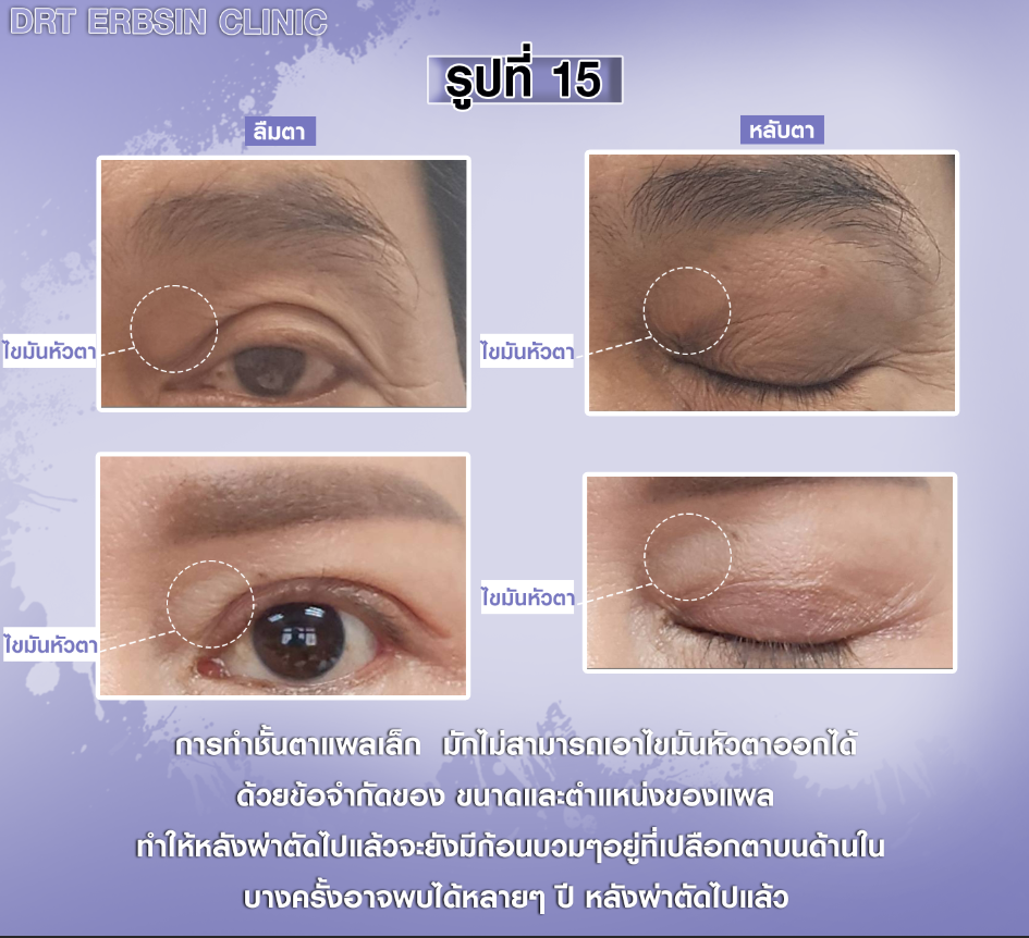 ไขมันหัวตาเหลือค้างหลังผ่าตัดตา2ชั้น