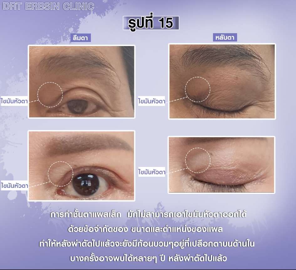 ไขมันหัวตาเหลือค้างหลังผ่าตัดตา2ชั้น ไขมันหัวตาเหลือค้างหลังผ่าตัดตา2ชั้น