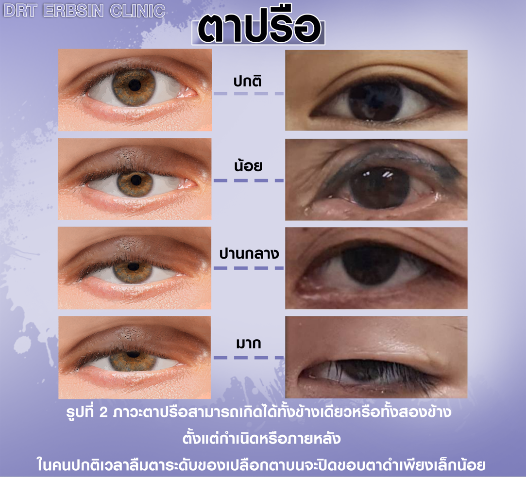 ตาปรือ กล้ามเนื้อตาอ่อนแรง