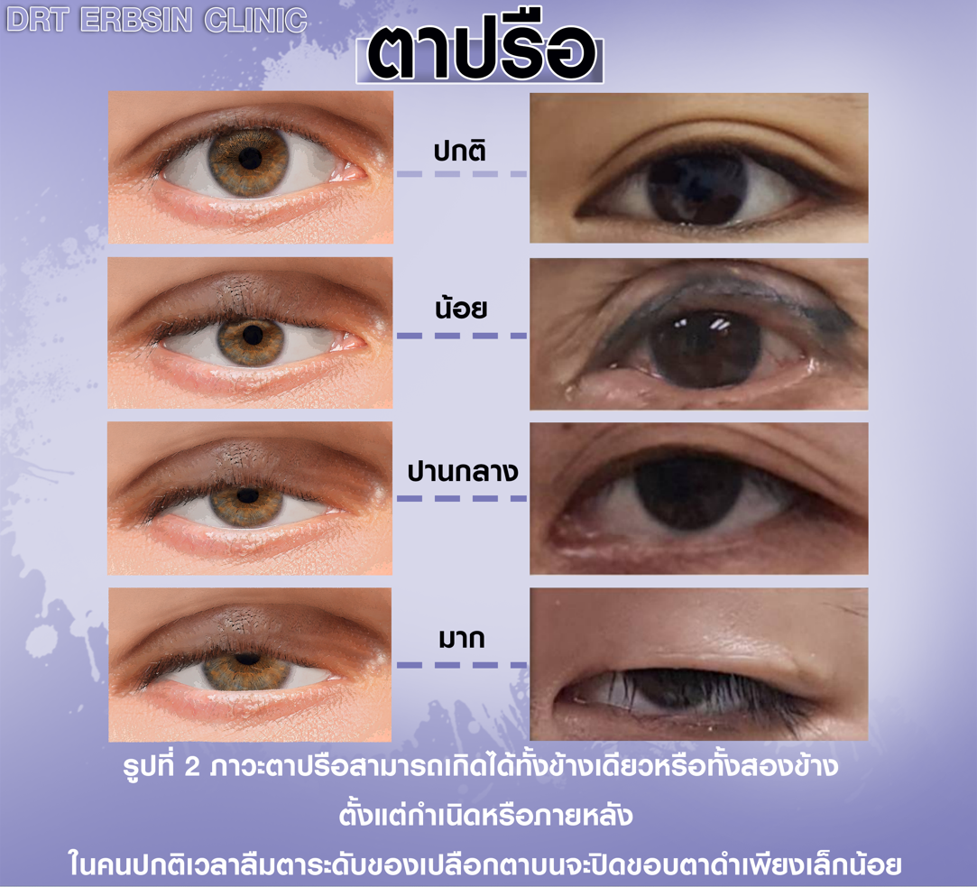 ตาปรือ ตาปรือ กล้ามเนื้อตาอ่อนแรง