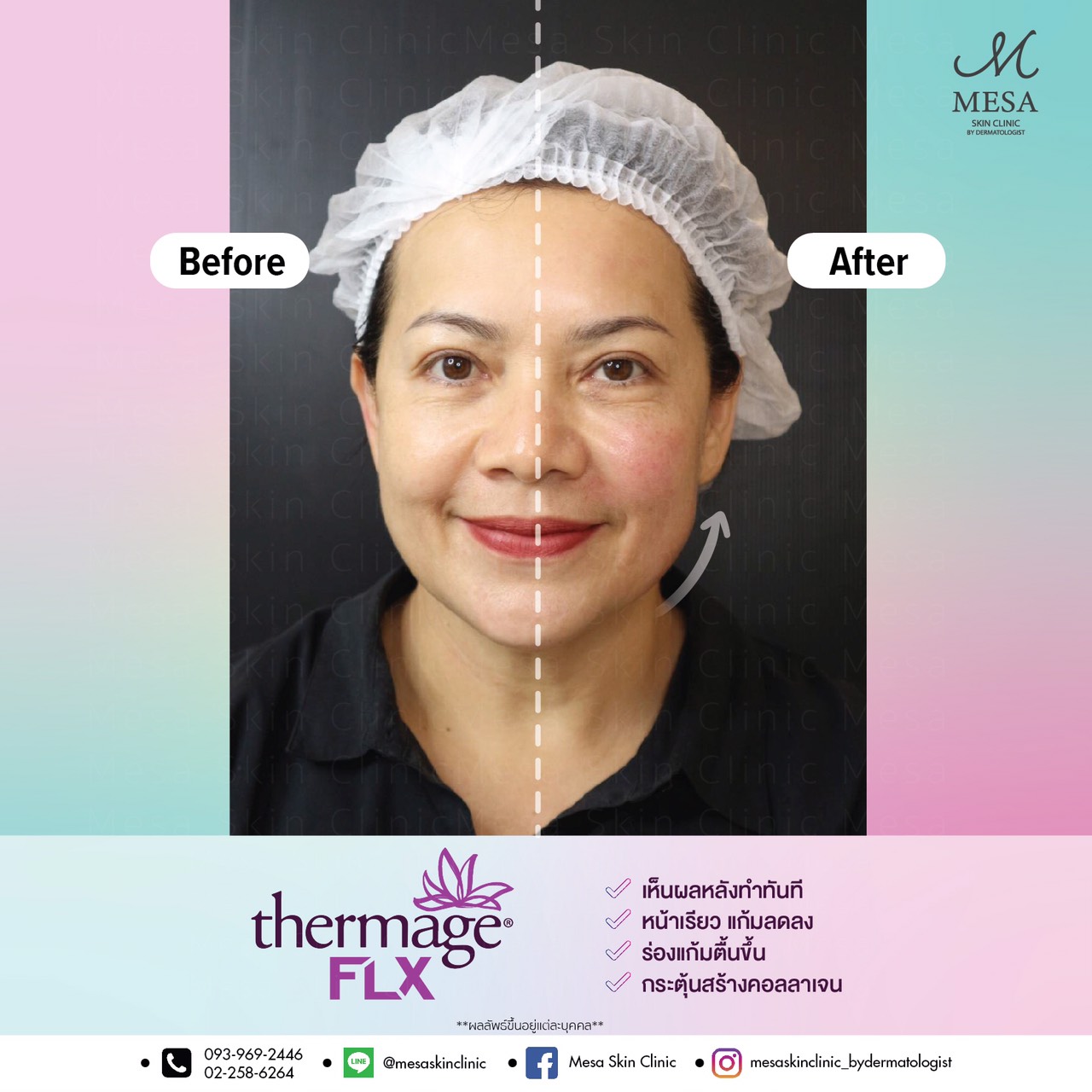 ThermageFLX เทอมาจหัวม่วง