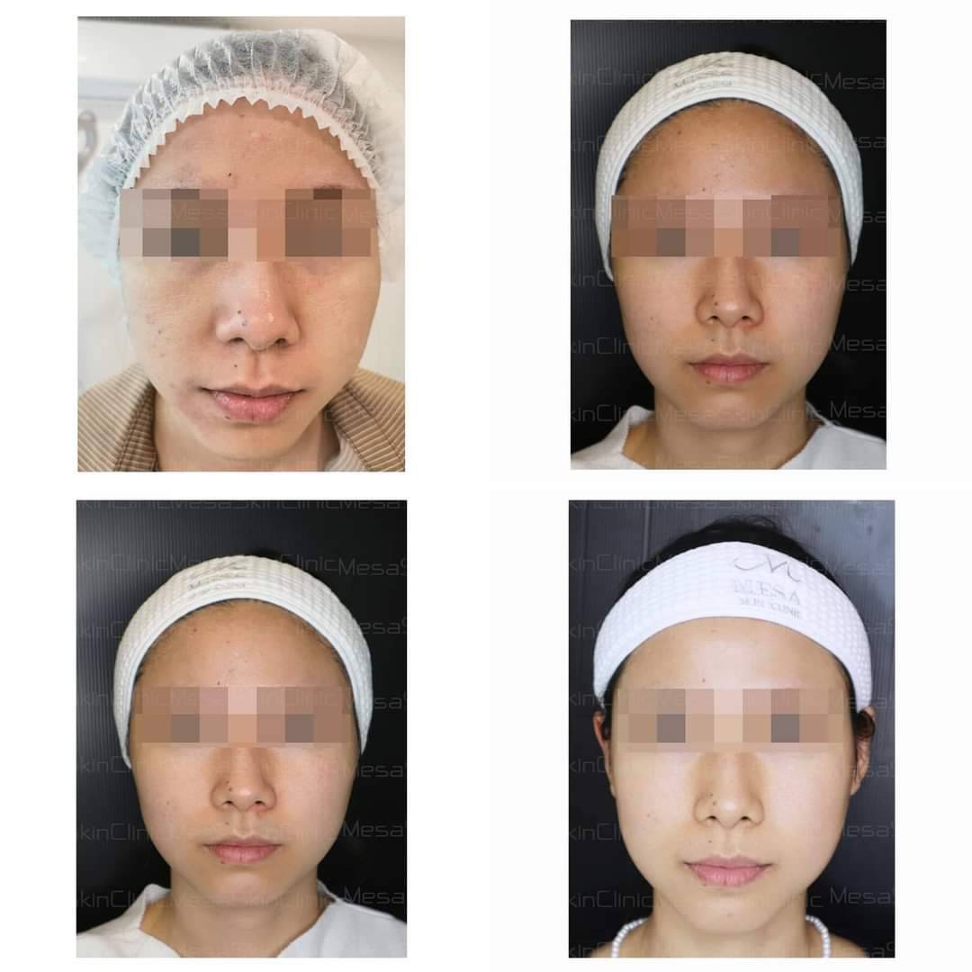 รีวิว HIFU REJU