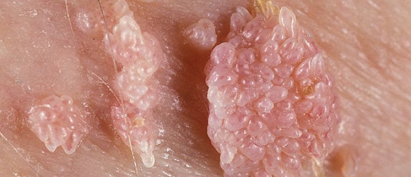 Genital warts (condyloma acuminata) clustered cauliflower-like papules on vulvar skin