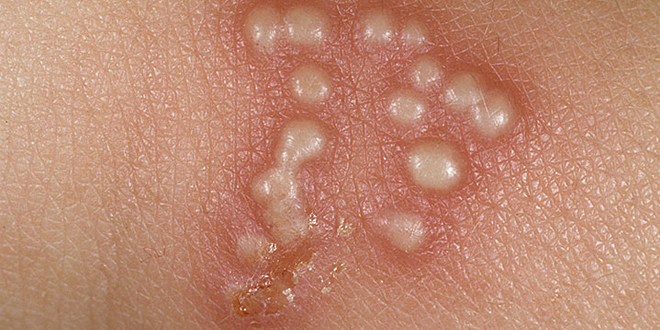 Genital herpes (HSV) grouped vesicles/pustules on an erythematous base causing burning pain