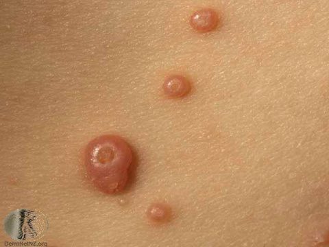 Molluscum contagiosum on vulvar/adjacent skinsmall dome-shaped papules with central umbilication