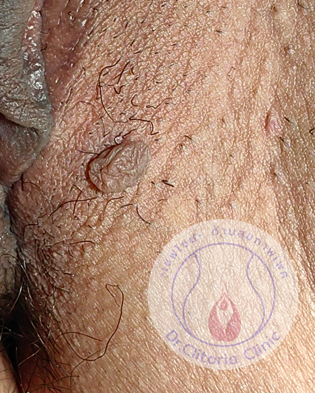 Vulvar skin tag or skin tag near the vaginal opening