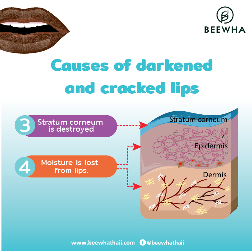 cause of dark and cracked lips2_Beewha