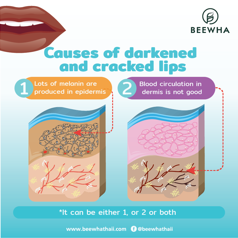 cause of dark and cracked lips1_Beewha