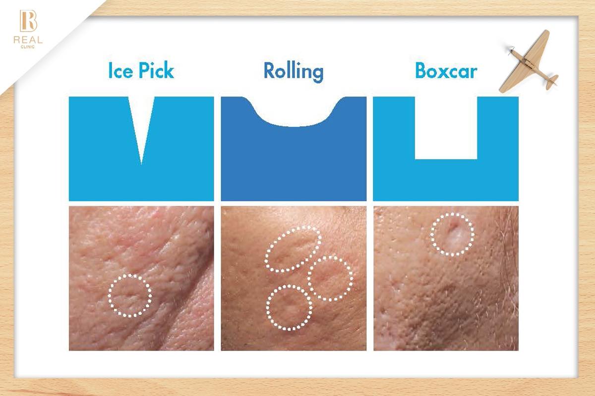 รักษาหลุมสิว ศัลยกรรมหลุมสิว เย็บหลุมสิว รักษาหลุมสิว ศัลยกรรมหลุมสิว เย็บหลุมสิว