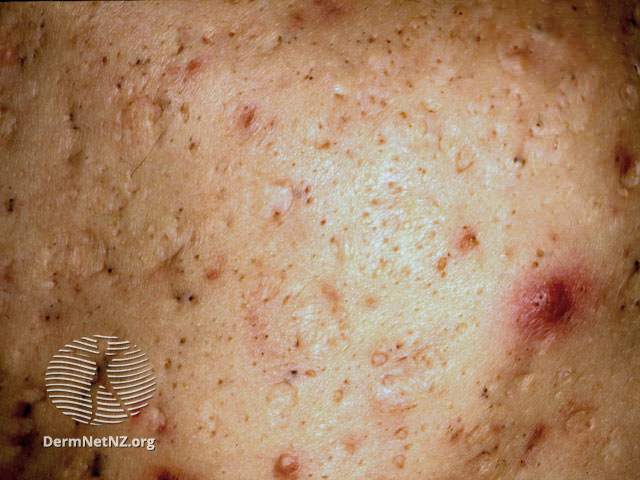 รักษาหลุมสิว ศัลยกรรมหลุมสิว เย็บหลุมสิว รักษาหลุมสิว ศัลยกรรมหลุมสิว เย็บหลุมสิว