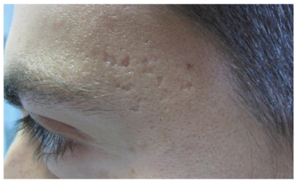 รักษาหลุมสิว ศัลยกรรมหลุมสิว เย็บหลุมสิว