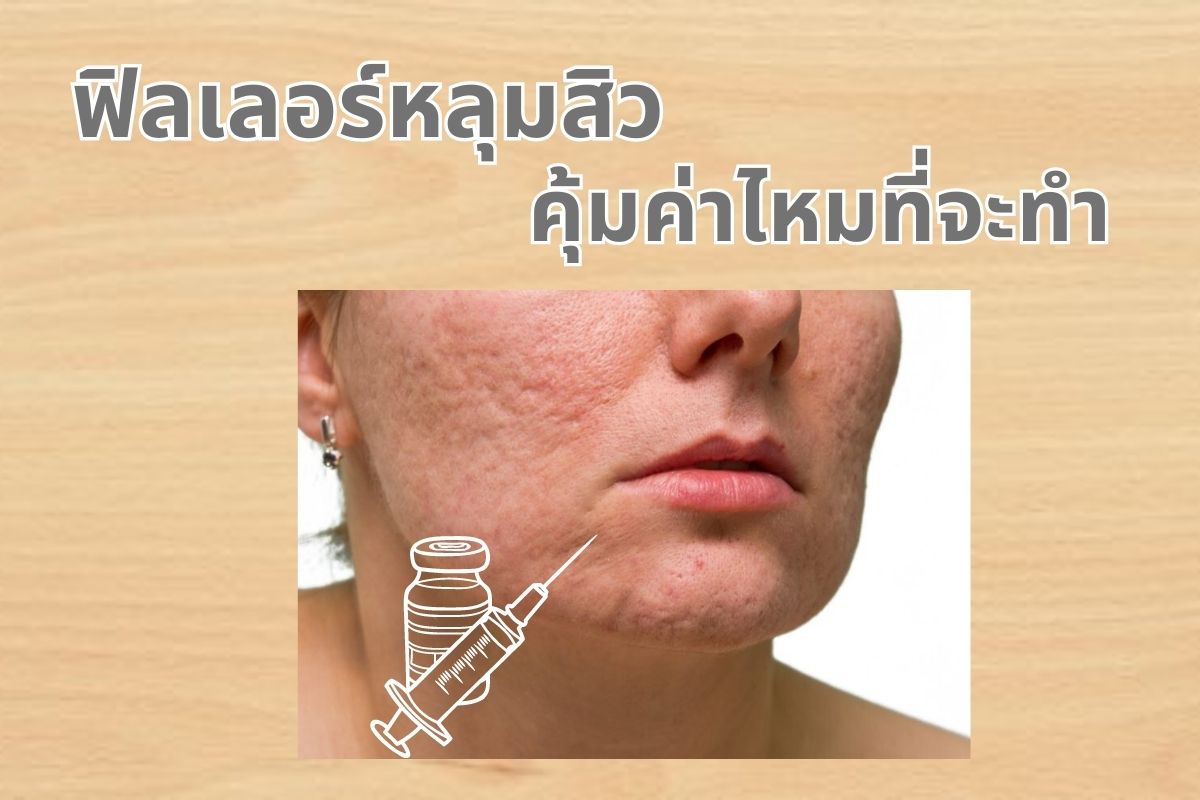 รักษาหลุมสิว,ตัดพังผืด,รักษาหลุมสิว, วิธีรักษาหลุมสิว, Fractional Laser, Microneedling, Subcision, เติมฟิลเลอร์, Real Scar Synergy, Juvgen,acnescarsurgery,acnescarrevision,รักษาหลุมสิวให้ตื้น,เลเซอร์หลุมสิว, รักษาหลุมสิวที่ดีที่สุด,รักษาหลุมสิวให้หายขาด,หลุมสิว,realclinic,drramita ฟิลเลอร์หลุมสิว