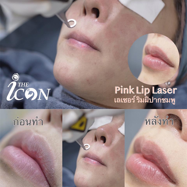 pink_lip_laser_%E0%B9%80%E0%B8%A5%E0%B9%80%E0%B8%8B%E0%B8%AD%E0%B8%A3%E0%B9%8C%E0%B8%9B%E0%B8%B2%E0%B8%81%E0%B8%8A%E0%B8%A1%E0%B8%9E%E0%B8%B9.jpg